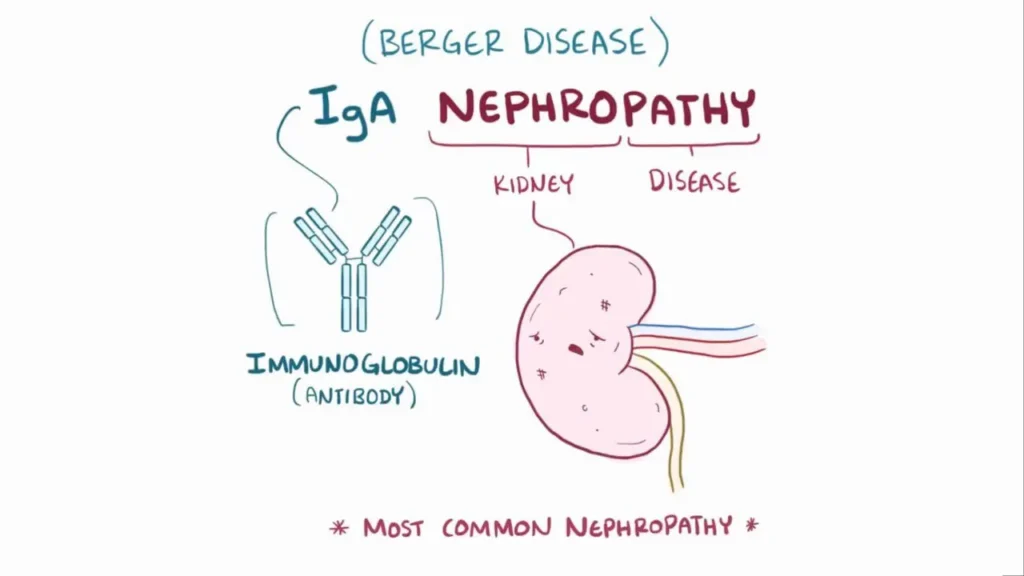 IgA Nephropathy | HeLovesMath Medical illustration of IgA nephropathy showing immunoglobulin antibody and kidney, labeled as Berger disease and most common nephropathy
