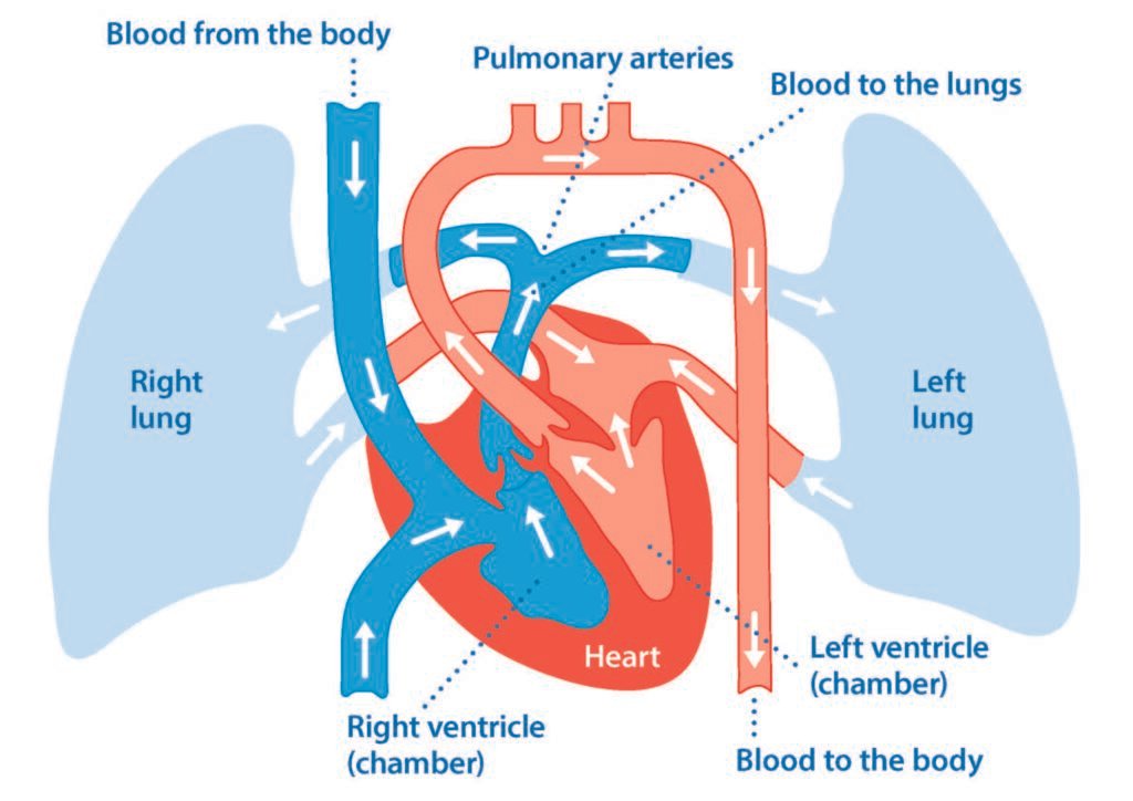 Medical diagram showing blood flow between heart, pulmonary arteries, and lungs, illustrating pulmonary hypertension and its impact on circulation