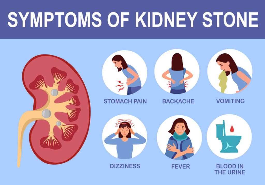Medical illustration showing kidney stone symptoms including stomach pain, backache, vomiting, dizziness, fever, and blood in urine