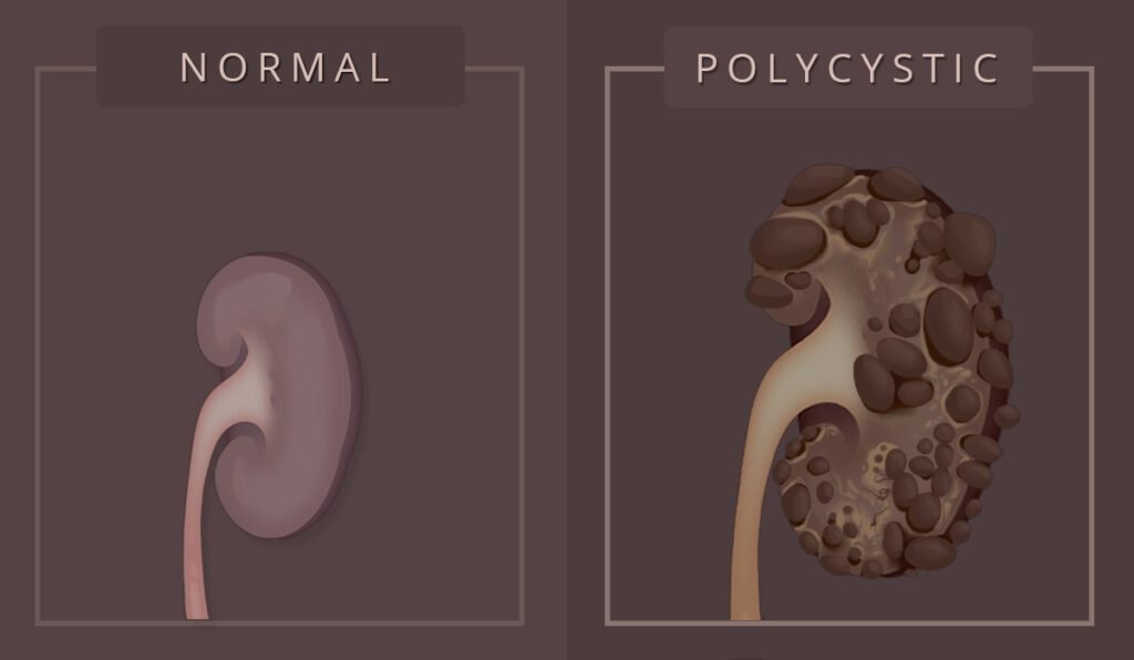 Polycystic Kidney Disease: An In-Depth Guide | HeLovesMath Medical illustration comparing normal kidney and polycystic kidney showing cyst formation and structural damage