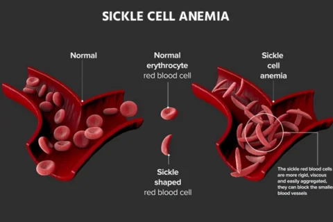 Sickle Cell Disease: A Guide to Symptoms, Diagnosis, Treatment, and Support | HeLovesMath Medical diagram showing comparison of normal red blood cells and sickle-shaped cells causing sickle cell anemia and blood vessel blockage