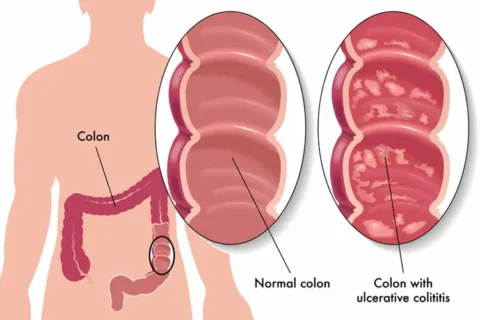 Medical illustration comparing normal colon and colon affected by ulcerative colitis with inflammation and ulcers
